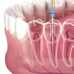 tooth hemisection