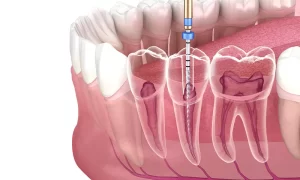 tooth hemisection